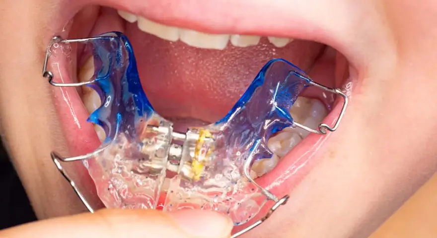 Boca de niño con aparato dental azul y transparente.