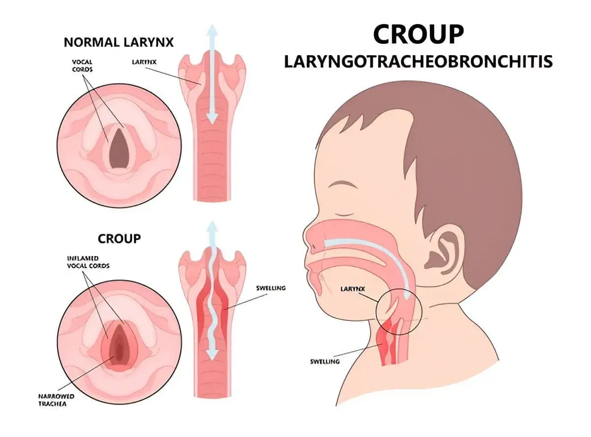 Ilustración compara laringe normal y la de un niño con crup, mostrando inflamación y estrechamiento de la tráquea, síntomas de laringitis en niños.