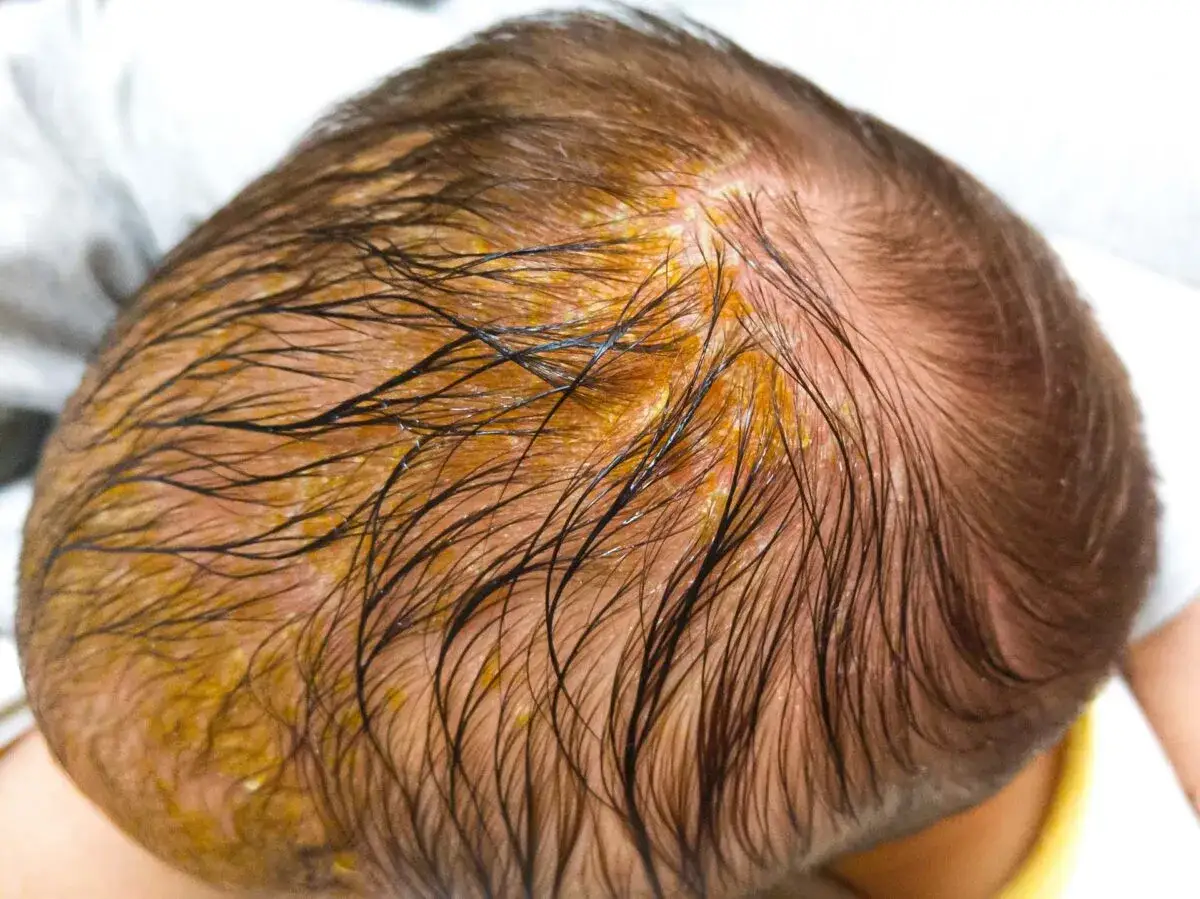 Cabeza de bebé con costra láctea, mostrando escamas amarillentas y grasosas entre el cabello oscuro y húmedo.