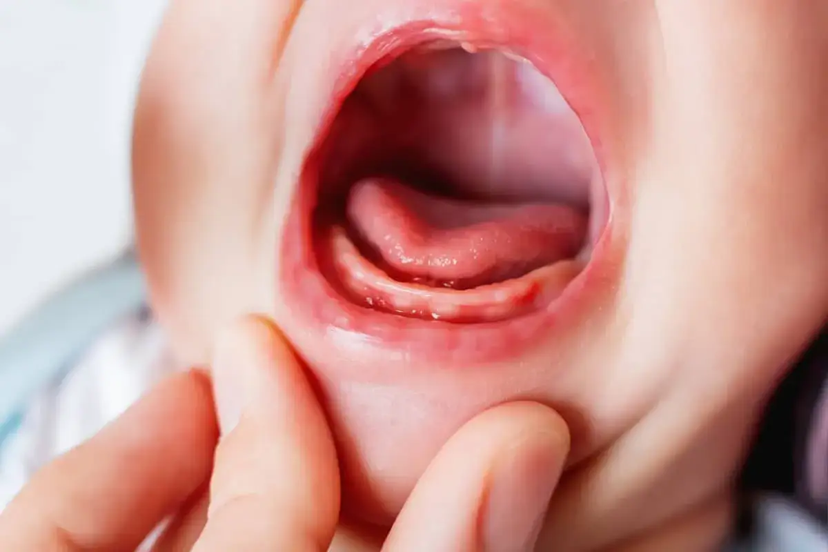 Bebé con encías inflamadas y rojas, mostrando los primeros dientes asomando. El dolor encias bebe es evidente.