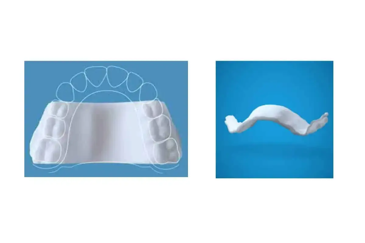 Molde dental que muestra un paladar ojival en ni&ntilde;os. El aparato se adapta a la forma del paladar para corregir la mordida.