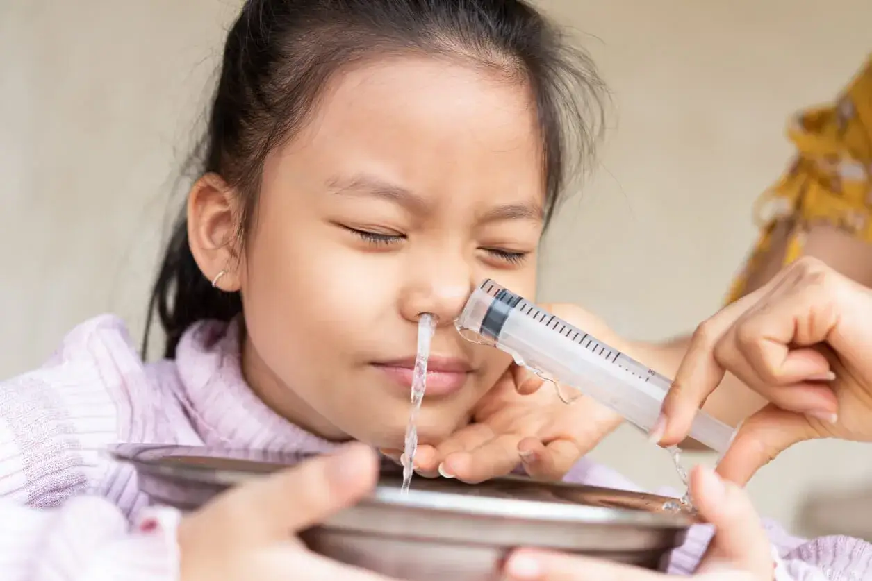 Ni&ntilde;a con los ojos cerrados recibe irrigaci&oacute;n nasal para quitar mocos. El agua sale por la otra fosa nasal hacia un recipiente.
