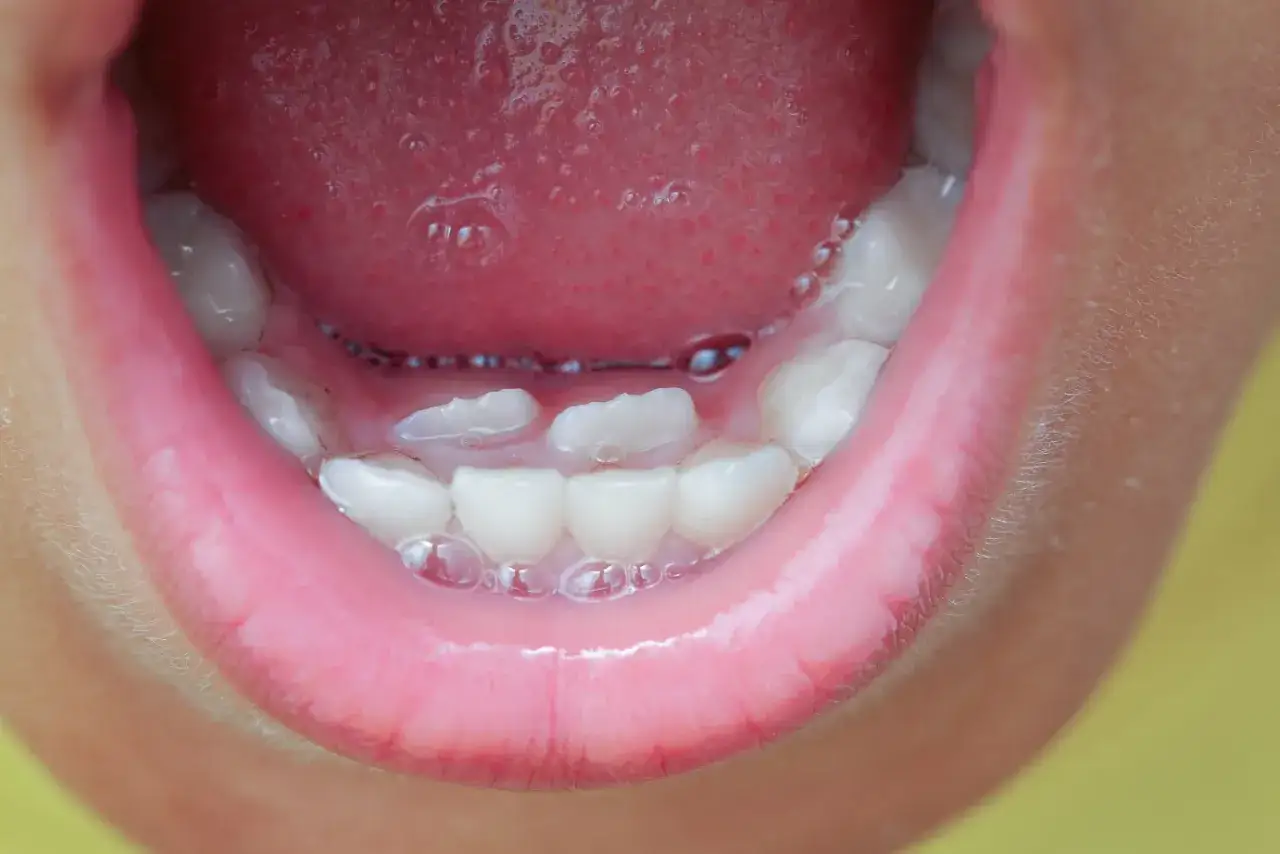 Boca de niño con dientes de tiburón asomando, algunos incisivos temporales y molares permanentes.