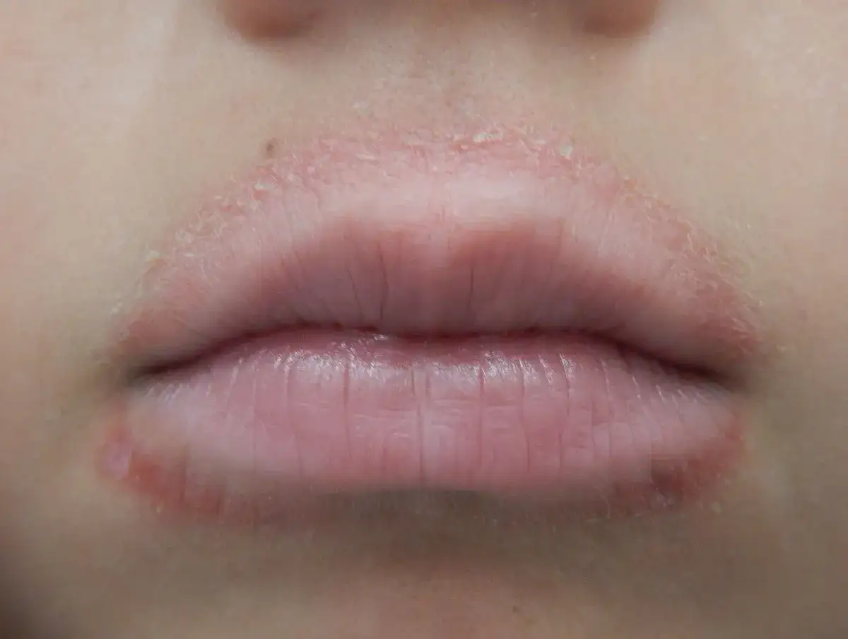 Sarpullido alrededor de la boca en niños, con piel seca y escamosa en los labios y la zona peribucal.
