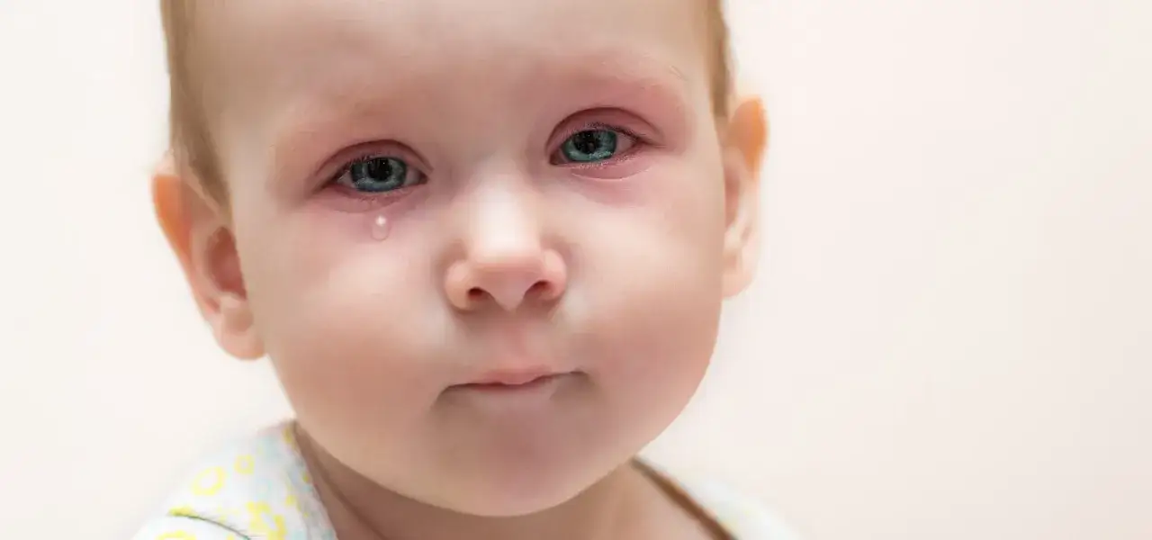 Ojos rojos e irritados de un bebé, con una lágrima cayendo. Posible conjuntivitis vírica en el bebé.