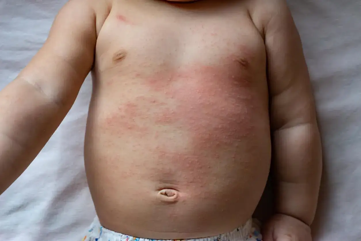 Piel enrojecida y con peque&ntilde;os bultos en el pecho de un beb&eacute;, indicativo de dermatitis por calor o sudor.