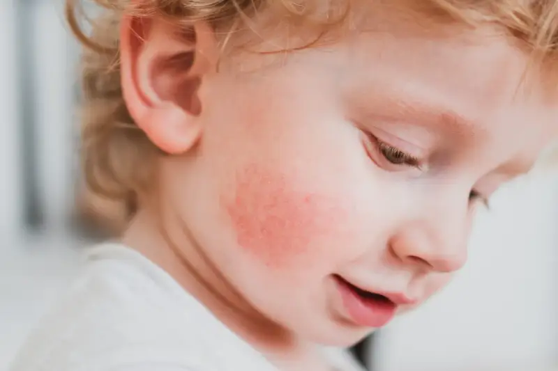 Rojo en la mejilla de un bebé, posible alergia a fruta, con síntomas visibles.