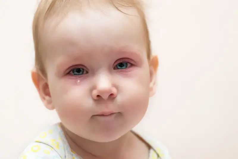 Bebé con ojos rojos e irritados, una lágrima cayendo, indicativo de conjuntivitis vírica.